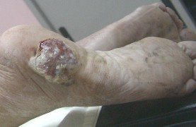 Image:Skin_cancer_photo3.jpg