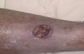 Image:Skin_cancer_photo2.jpg