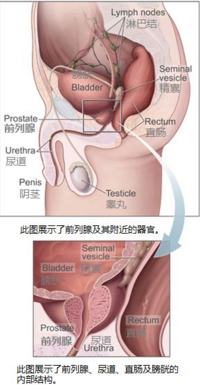 http://upload.wikimedia.org/wikipedia/commons/2/2e/Prostatelead_zh.jpg